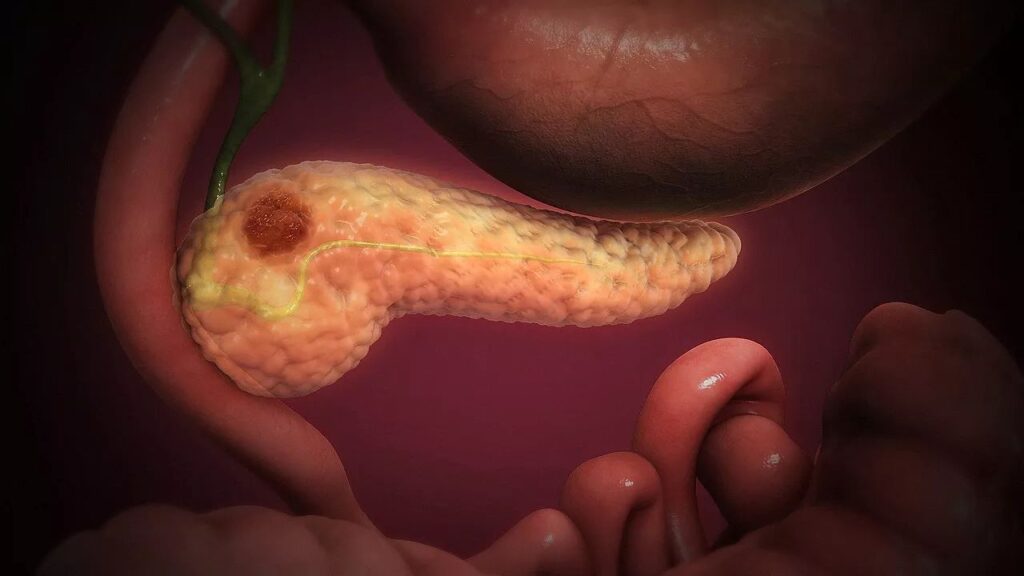 crescem-casos-de-cancer-de-pancreas-antes-dos-50-anos;-aumento-e-maior-entre-mulheres